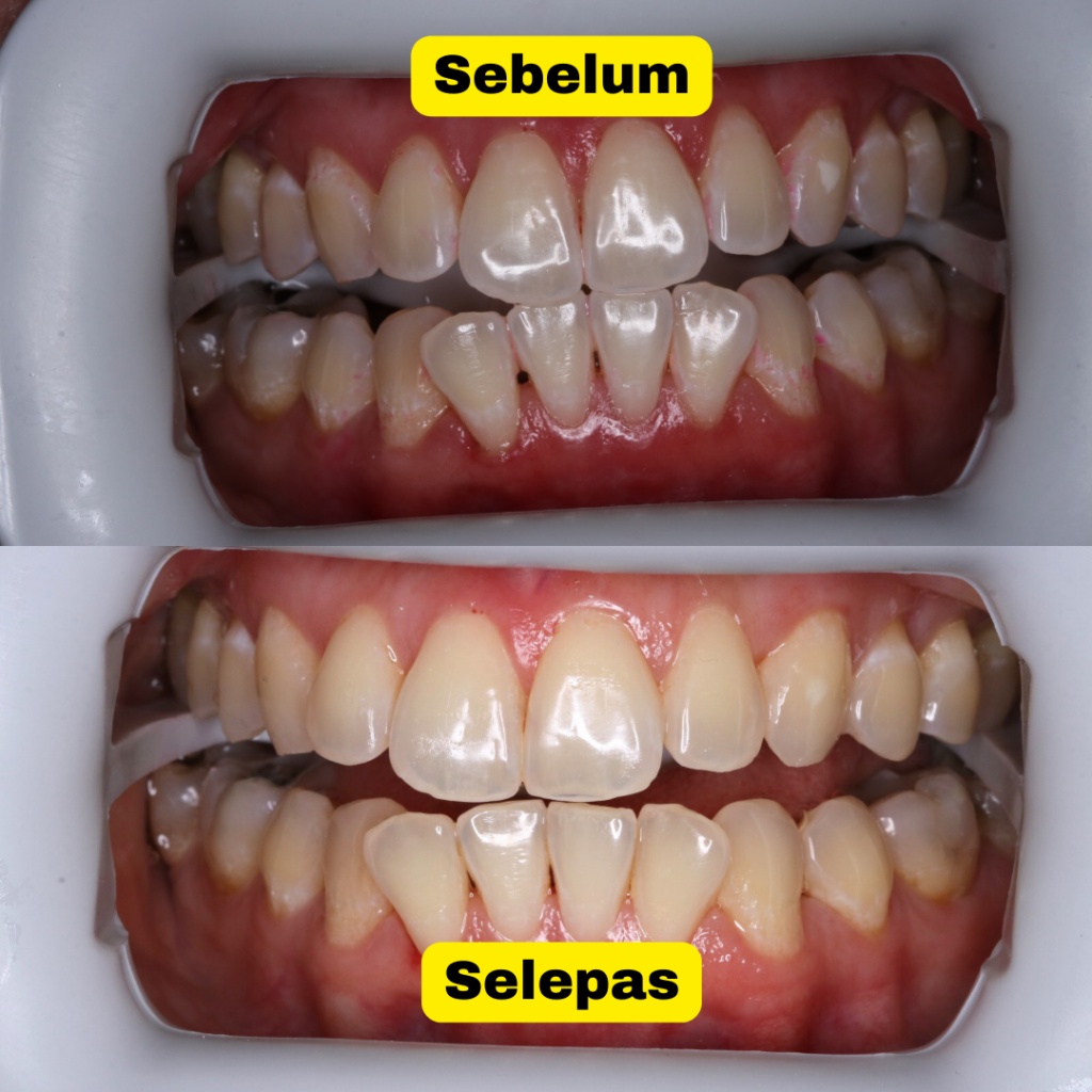 hasil whitening
