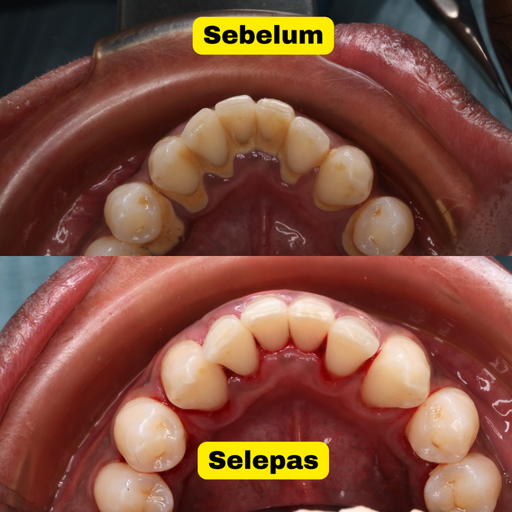 hasil whitening 1