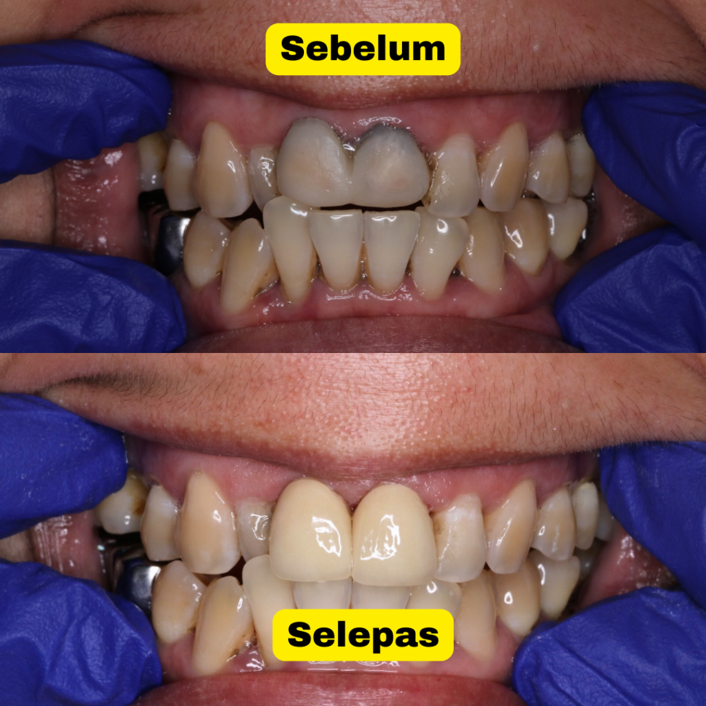 hasil whitening 3