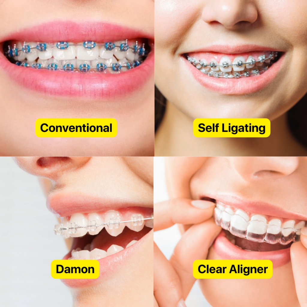 jenis braces