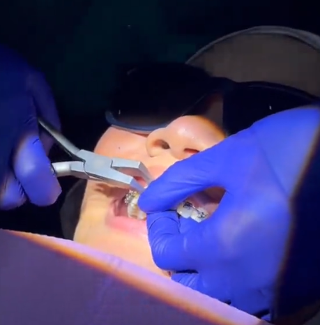 bond up braces