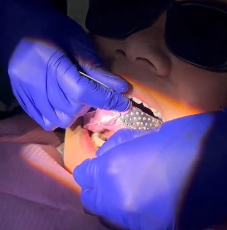 mould braces